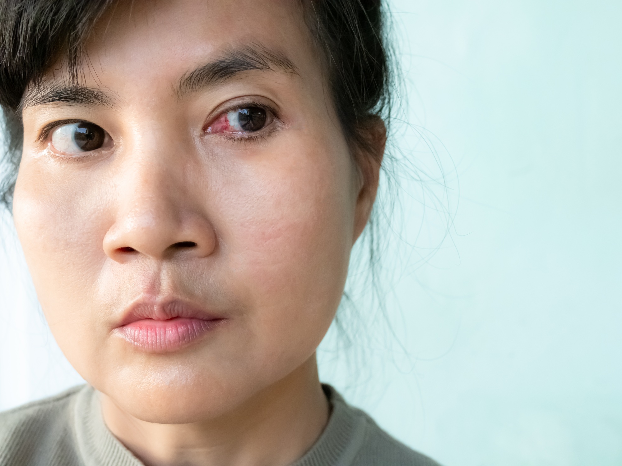 Pterygium cataract eyes inflammation